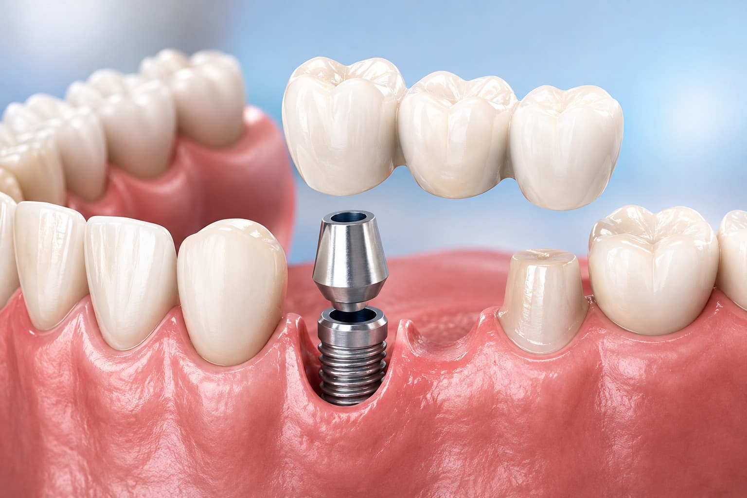 Crown, Bridge & Implants