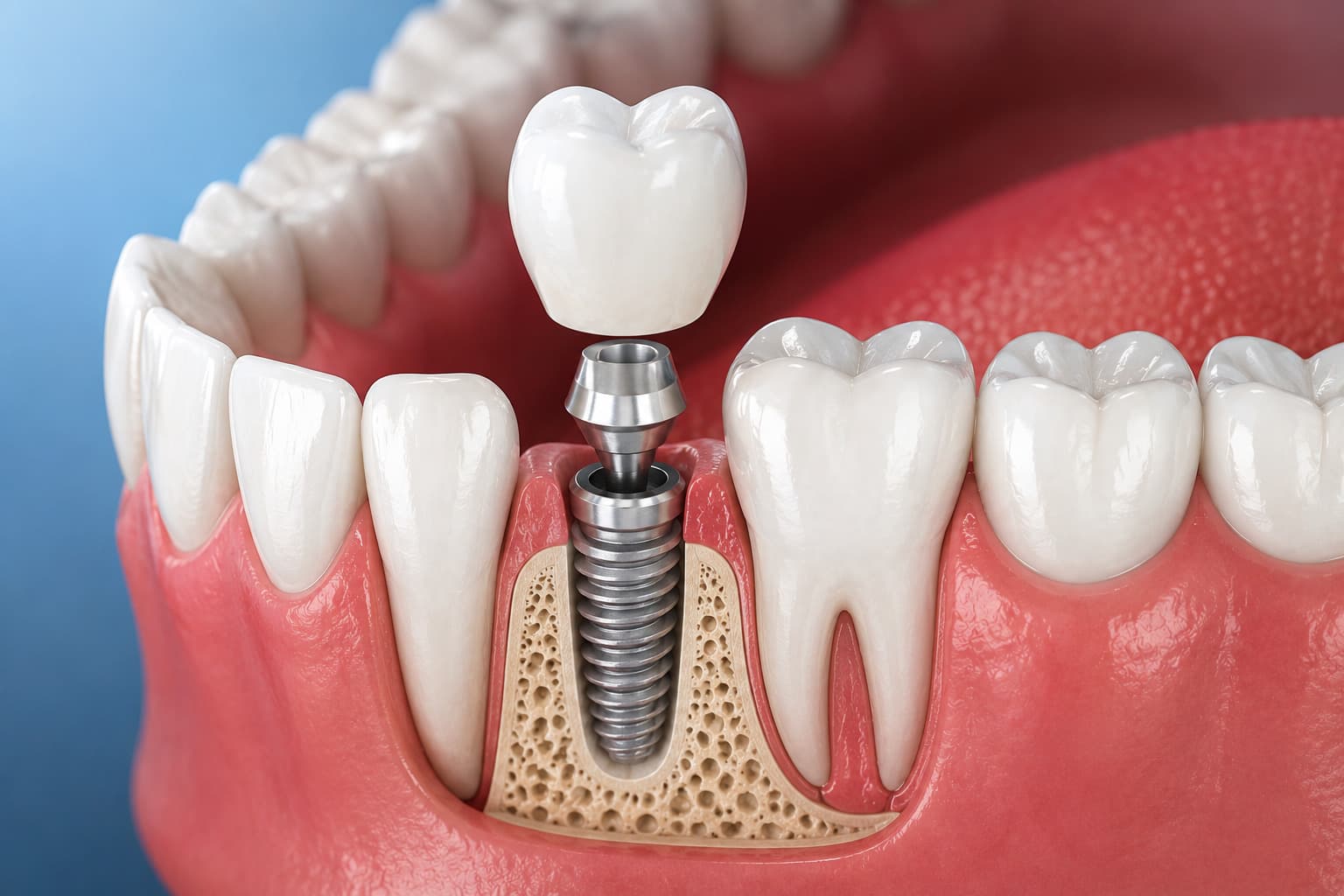 Dental Implants